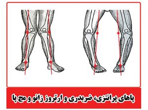 پاهای پرانتری، ضربدی و ارتروز زانو و مچ پا