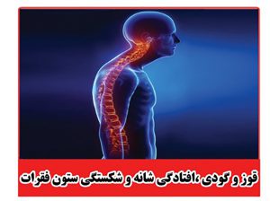 قوز و گودی، افتادگی شانه و شکستگی ستون فقرات