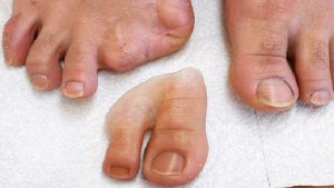 پروتز زیبایی