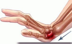 شکسته شدن مچ دست