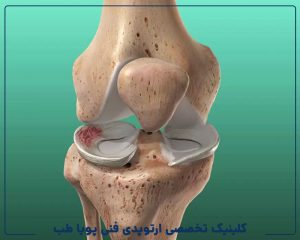 آسیب منیسک زانو و گزینههای درمان