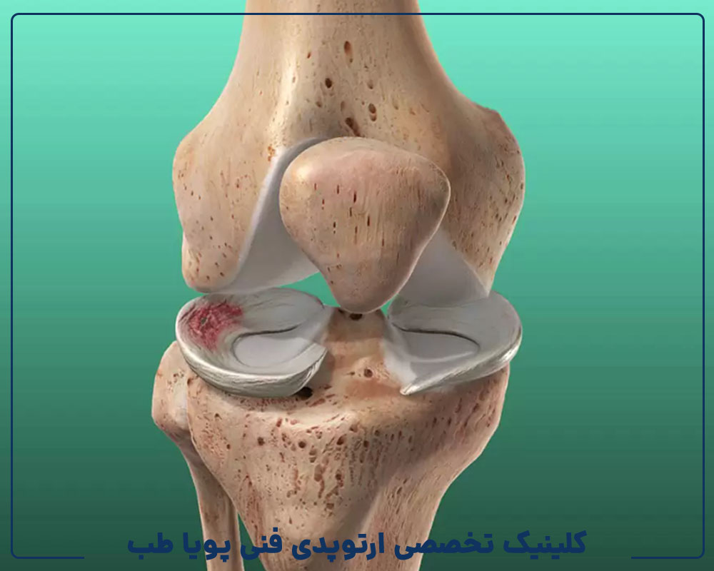 آسیب منیسک زانو و گزینه‌های درمان