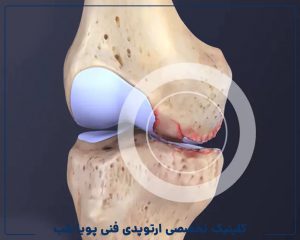 آرتروز زانو: علل، علائم و درمان