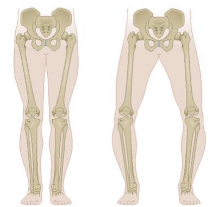 درمان زانو پرانتزی و پای پرانتزی در تهران جردن و خرم آباد