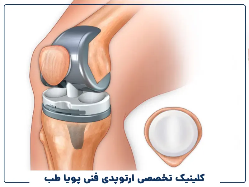 تعویض مفصل زانو بدون جراحی