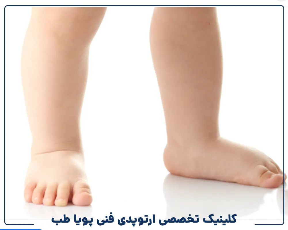 درمان تخصصی صافی کف پا کودکان بدون جراحی