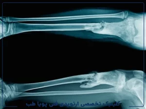 روشهای نوین در ایمپلنتهای ارتوپدی