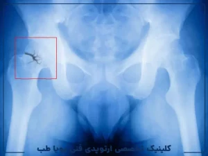 درمان شکستگی لگن در سالمندان