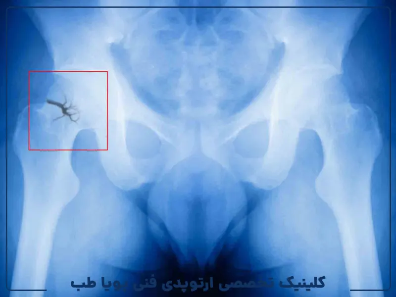 درمان شکستگی لگن در سالمندان