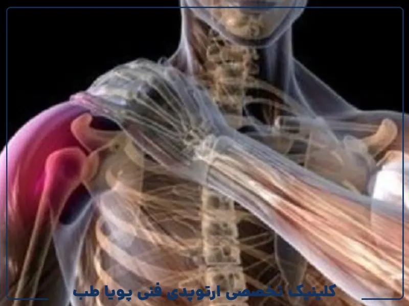 آسیب شانه ناشی از ورزش