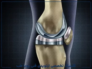 بازسازی غضروف در مفصل زانو