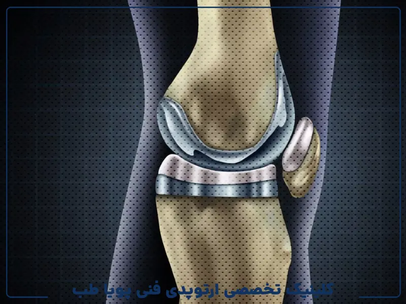 بازسازی غضروف در مفصل زانو